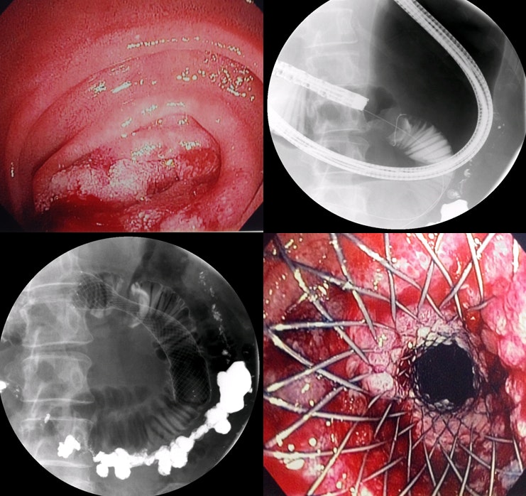 Placing A Self Expanding Metal Stent Into The Duodenum 3 Placing A Self Expanding Metal Stent Into The Duodenum