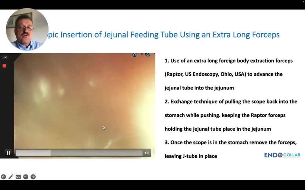 Placing Jejunal Feeding Tube Using the Extra Long Forceps