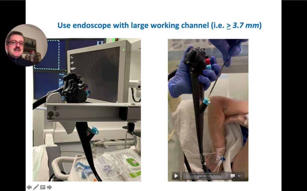 Placing Self-Expanding Metal Stents Into the Pylorus or Duodenum