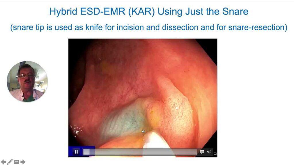 Polipectomía Híbrida: El Concepto To Kar – Knife Assisted Resection