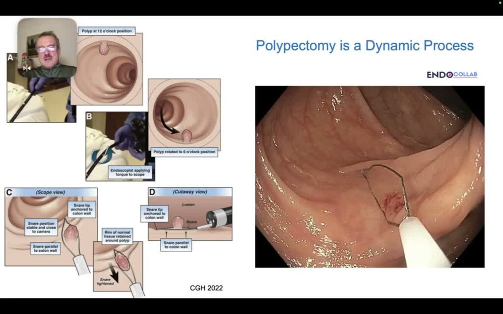 Polypectomy – which snare for which polyp?
