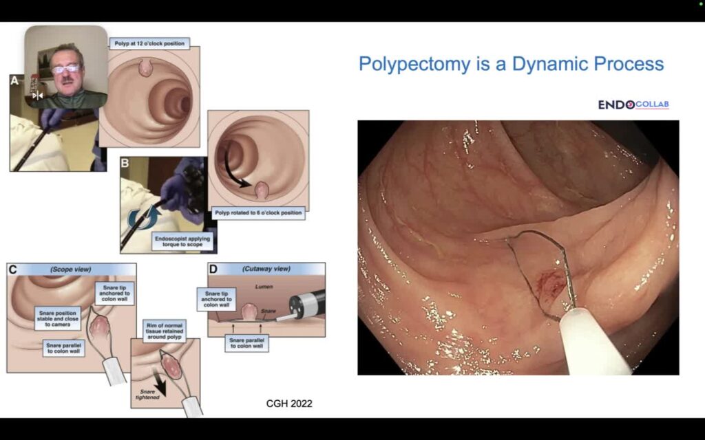 Polypectomy: Which Snare for Which Polyp?