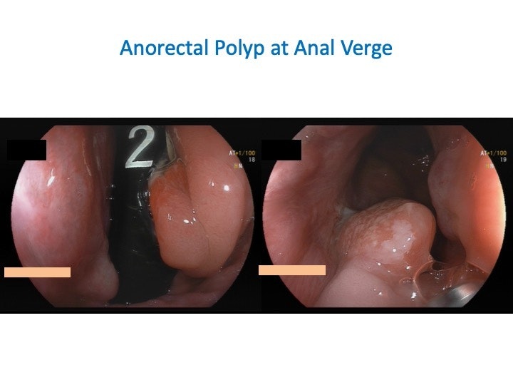Polypoid Lesion At The Anal Verge