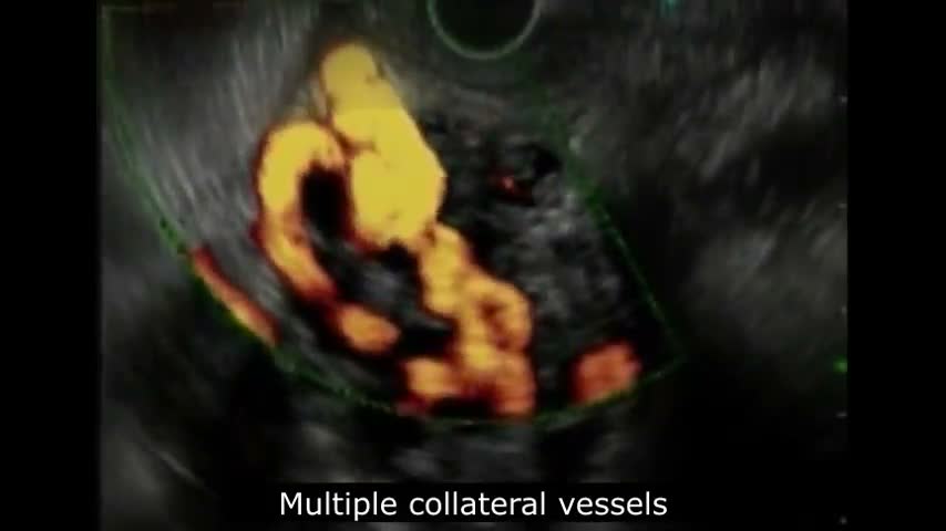 Portal Thrombosis With Cavernous Degeneration, Secondary To Neoplasm Of The Head Of The Pancreas