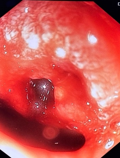 Gi Endoscopy Community &Amp; Education - Endocollab