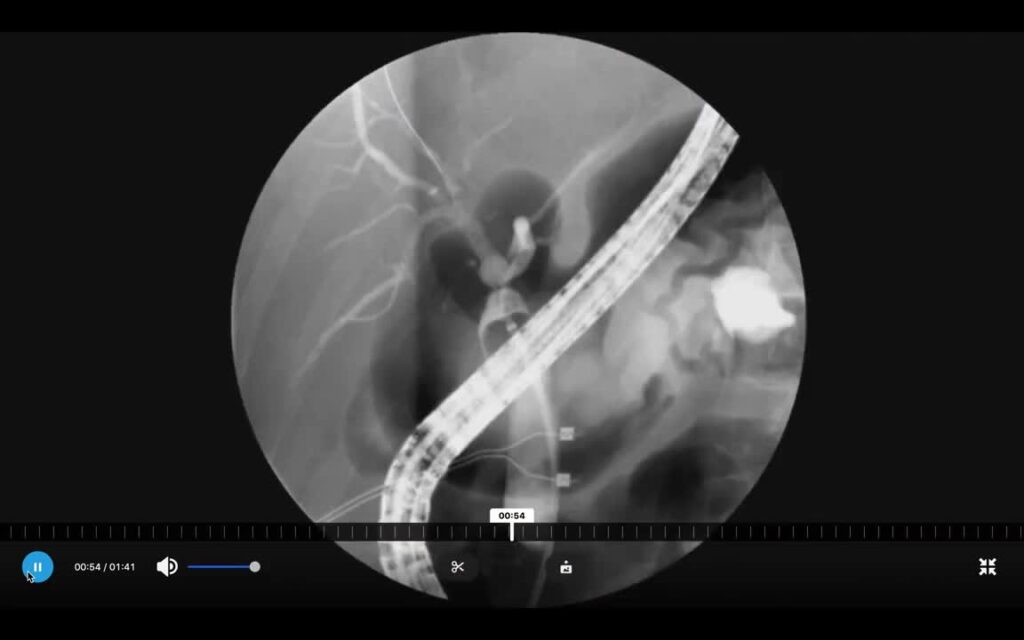 Complex Post Liver Transplant Stricture – Using The Soehendra Retriever