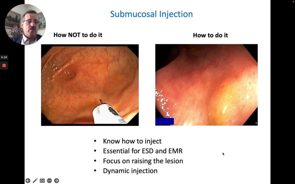 Post-Polypectomy Bleeding: Tips To Prevent And Treat