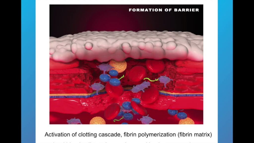 Post-Resection Hemostasis Using Hemospray