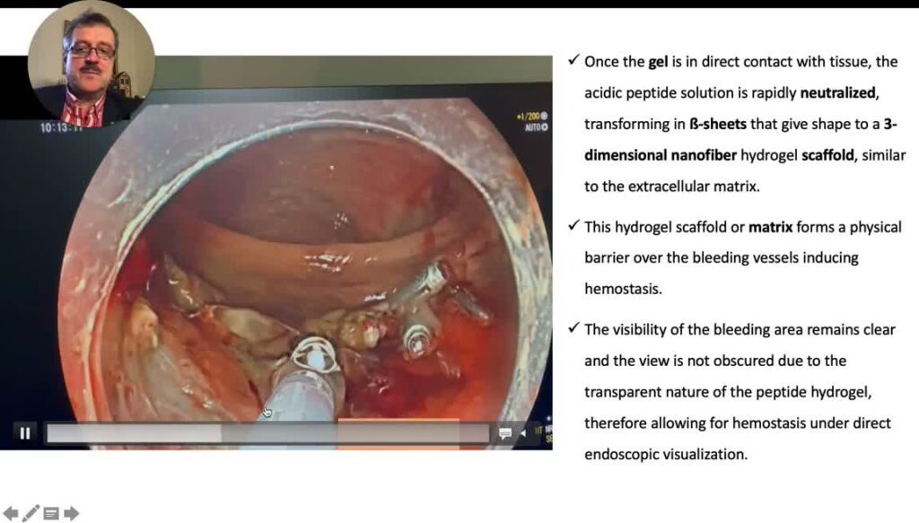Post-Resection Hemostasis Using Purastat