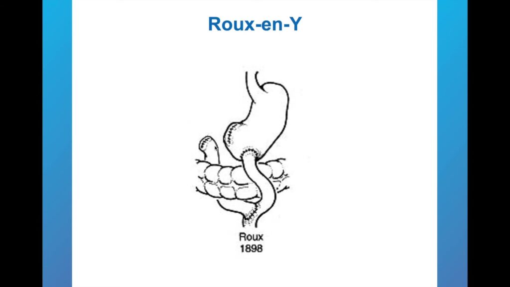 Post-Surgical Upper Gi Anatomy For Endoscopists