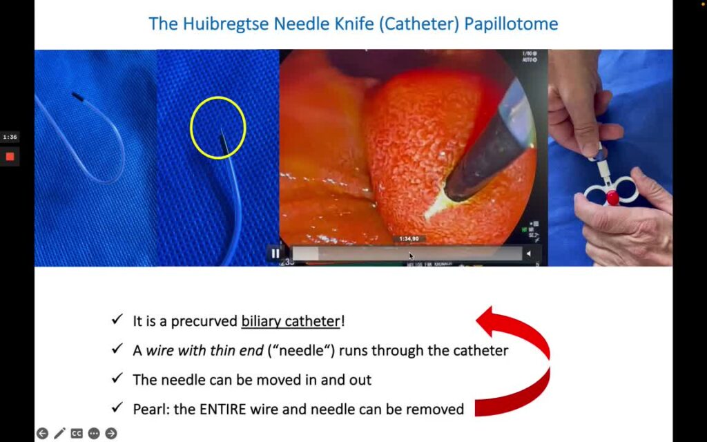 Pre-Cut Sphincterotomy Using The Huibregtse Needle Knife 19 Pre-Cut Sphincterotomy Using The Huibregtse Needle Knife