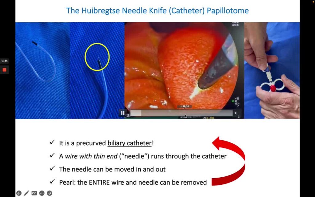 Precut and Bile Duct Cannulation Using The Huibregtse Needle Knife