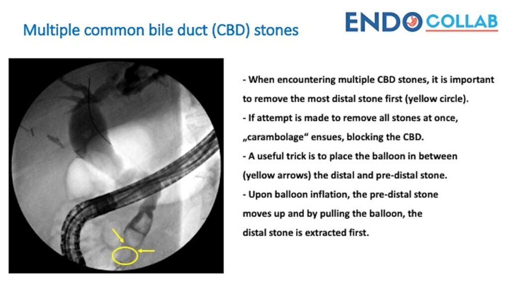 Prevention Of Carambolage During Removal Of Bile Duct Stones 9 Prevention Of Carambolage During Removal Of Bile Duct Stones