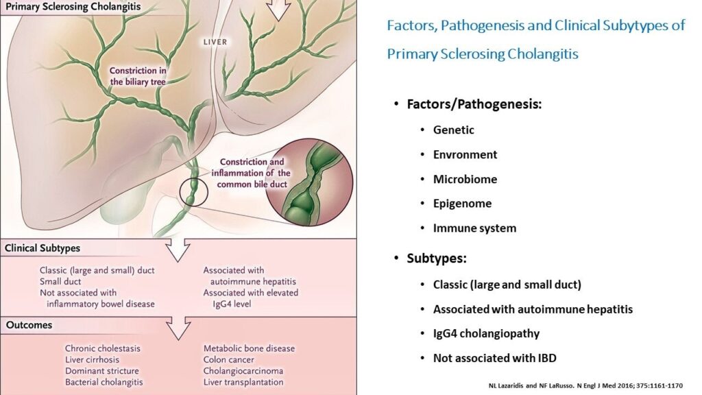 Primary Sclerosing Cholangitis