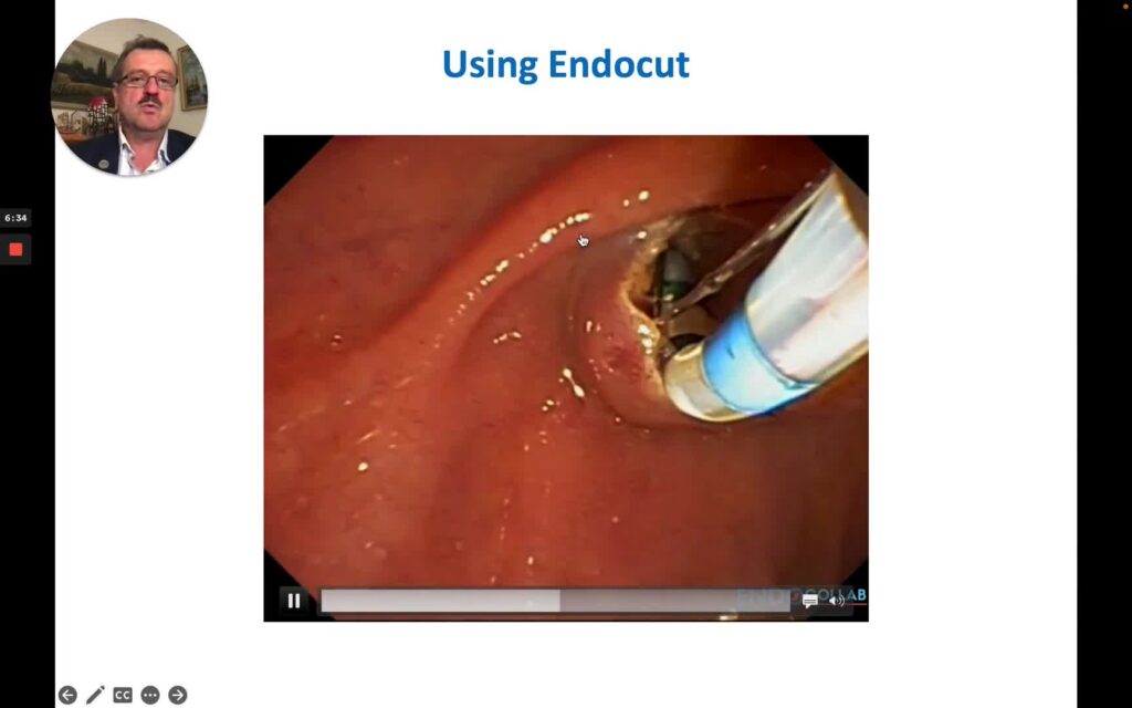 Principles Of Biliary Sphincterotomy