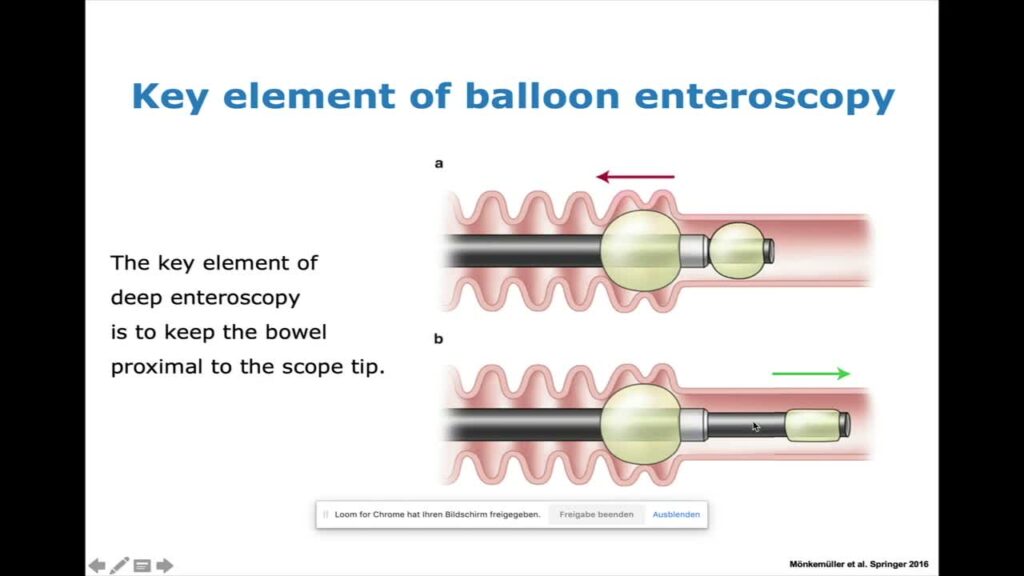 Principles Of Device-Assisted Enteroscopy 8 Principles Of Device-Assisted Enteroscopy