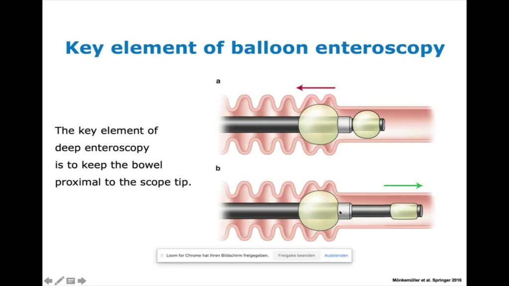 Principles Of Device-Assisted Enteroscopy