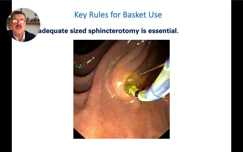 Principles Of Stone Extraction Using Baskets 2 Principles Of Stone Extraction Using Baskets