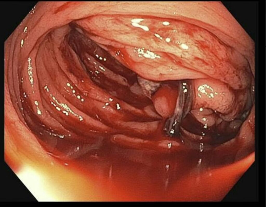 Profuse Hematochezia Of Rare Etiology 1 Profuse Hematochezia Of Rare Etiology