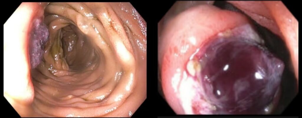 Proximal Jejunal Visible Vessel