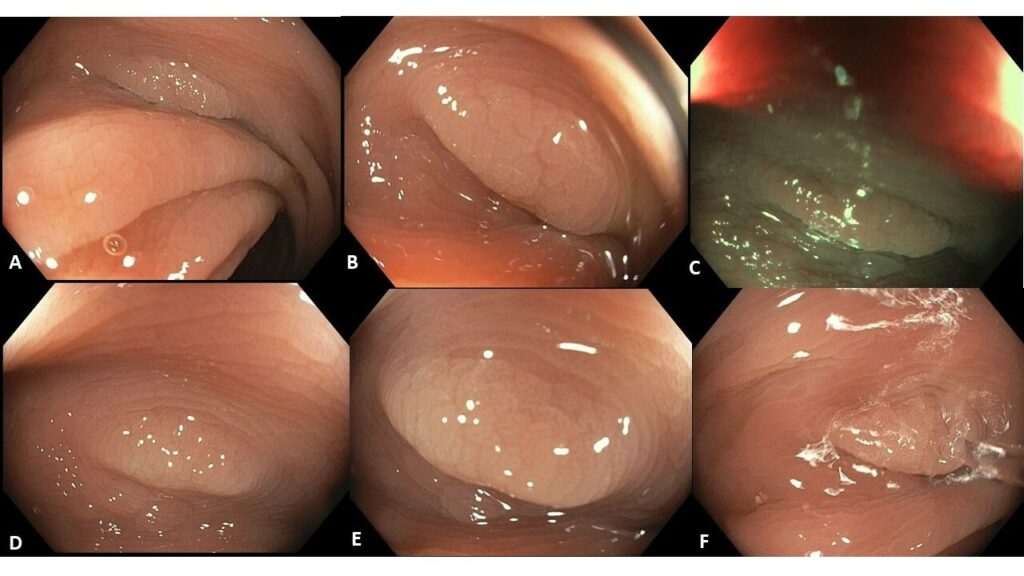 Pseudo-Polyp With Aurora Sign: Inverted Colon Diverticulum