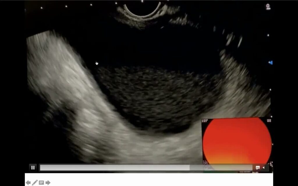 Pseudocyst of the Pancreas in Patient with Chronic Pancreatitis