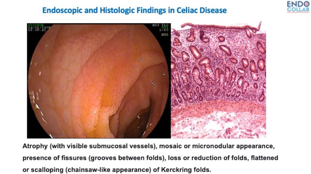 Quick Take On Celiac Disease 23 Quick Take On Celiac Disease