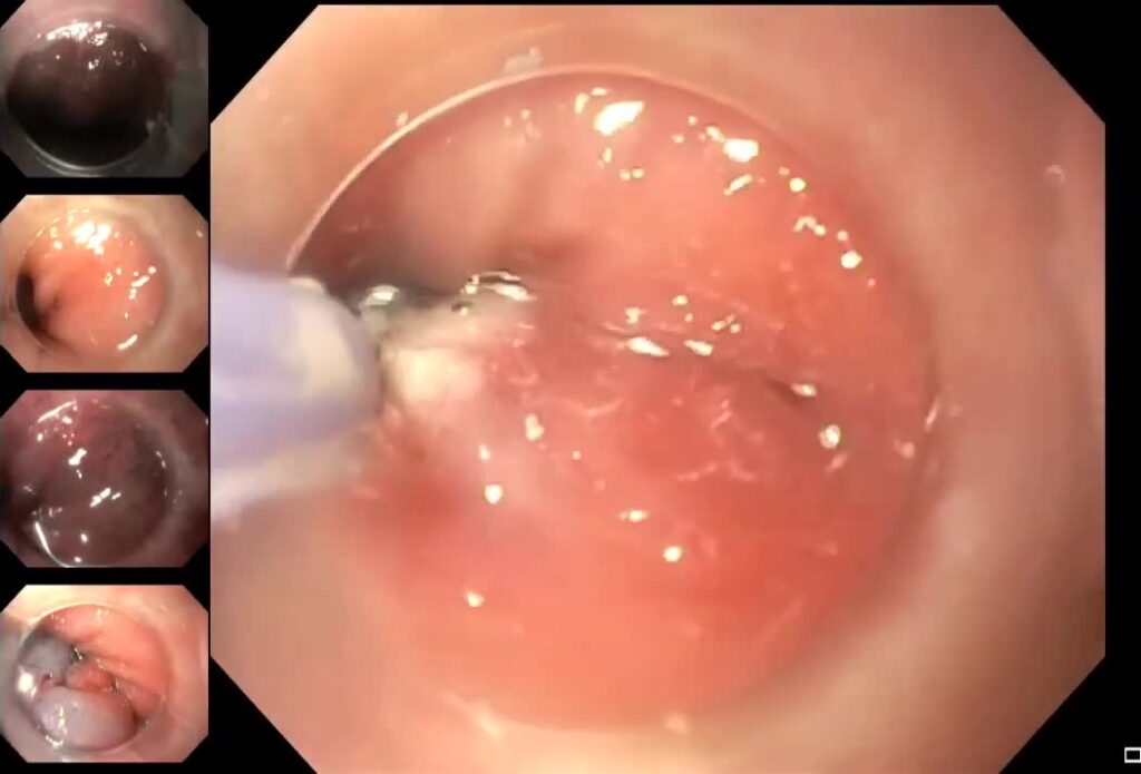 Cap-Assisted Esd For Dysplastic Barrett’s Esophagus
