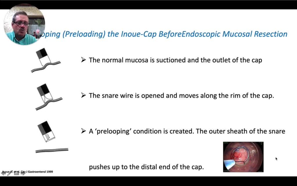 Endoscopic Resection Using The Oblique Cap (Inoue Cap)