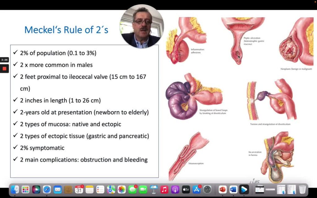 Meckel’s Diverticulum