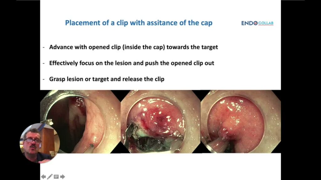 Quick Video Tip: Cap-Assisted Clip Placement For Ulcer Bleeding 1 Quick Video Tip: Cap-Assisted Clip Placement For Ulcer Bleeding