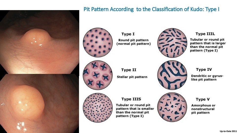 Rectal Carcinoid: Learn To Diagnose And Characterize This Lesion 13 Rectal Carcinoid: Learn To Diagnose And Characterize This Lesion