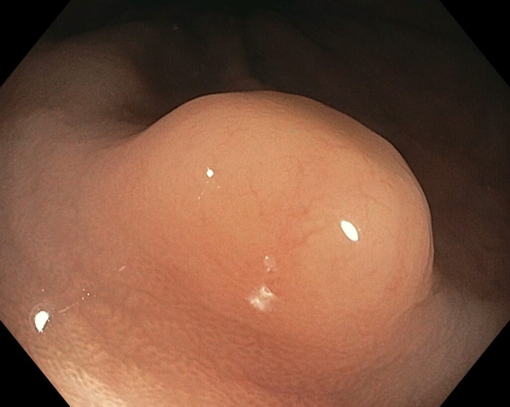 Rectal Carcinoid (Net) 8 Rectal Carcinoid (Net)