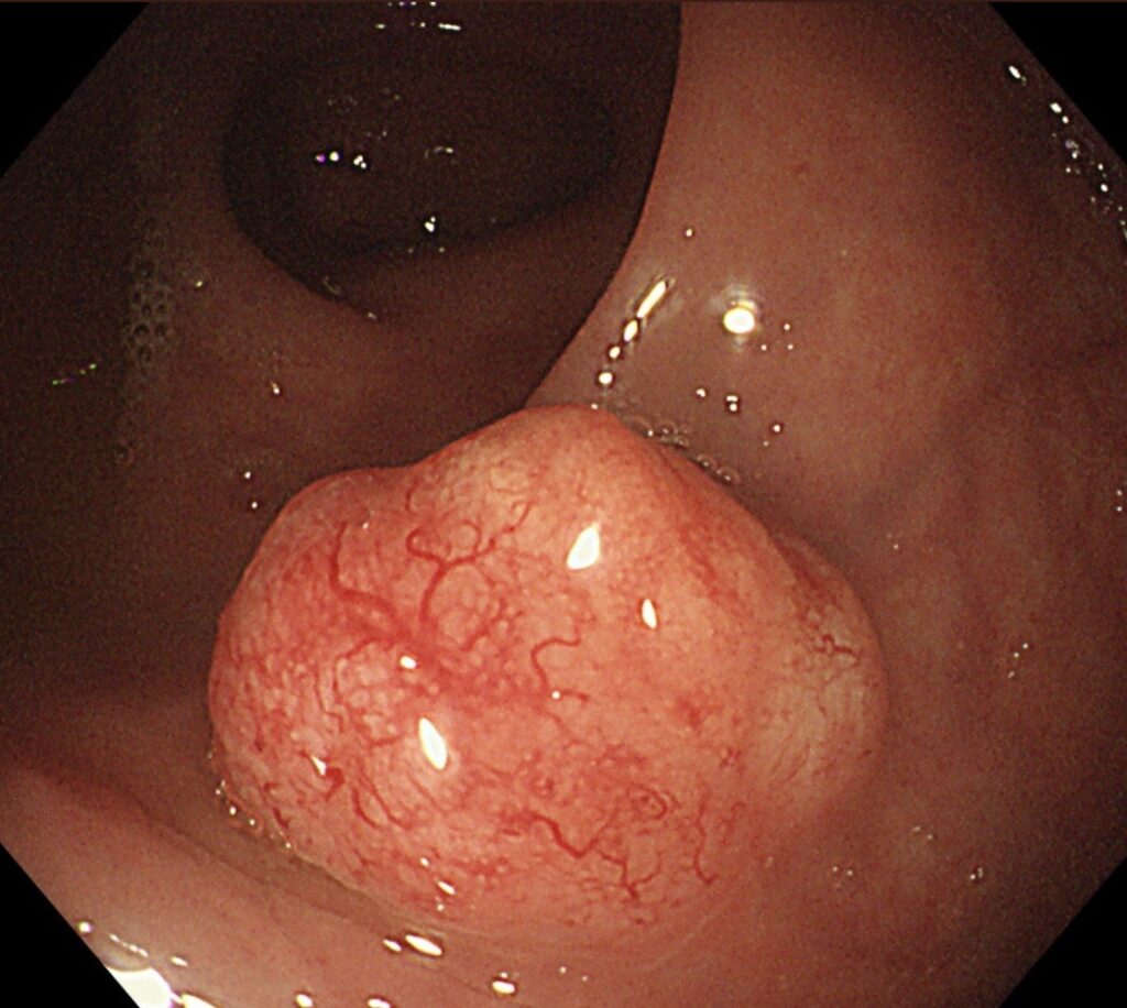 Rectal Polypoid Lesion - Typical Carcinoid (Net) 5 Rectal Polypoid Lesion – Typical Carcinoid (Net)