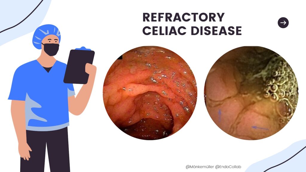 Refractory Celiac Disease