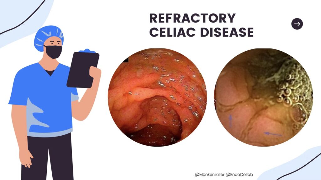 Refractory Celiac Disease 21 Refractory Celiac Disease