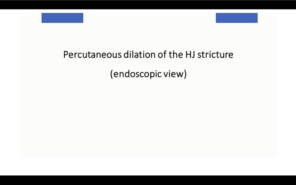 Rendezvous Ptcd – Device-Assisted Enteroscopy Ercp