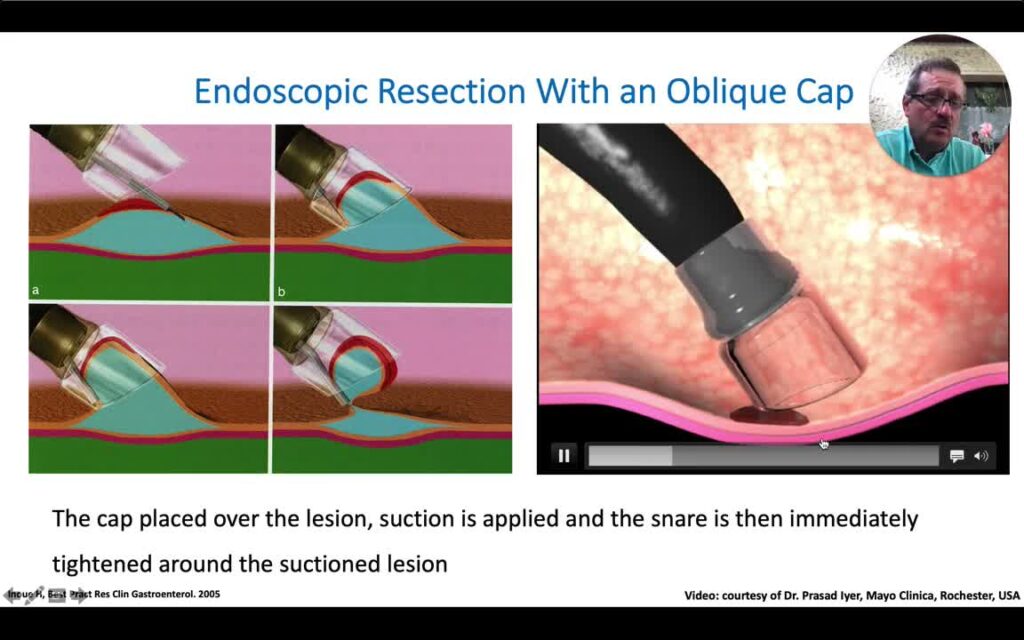 Resección Endoscópica Usando Cap Oblicuo (Cap de Inoue)