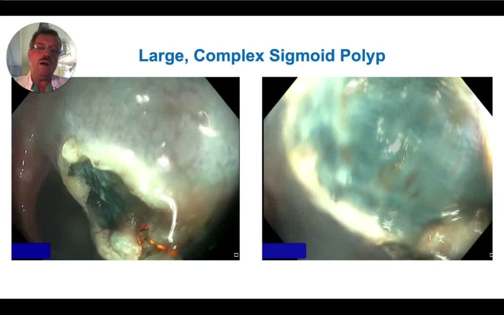 Resection Of a Complex Sigmoid Polyp