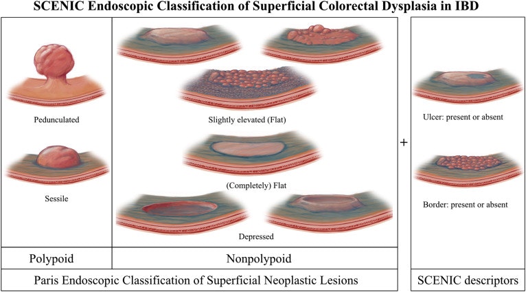 Scenic Guidelines For The Classification Of Polypoid Lesions In Ibd (Inflammatory Bowel Disease) 11 Scenic Guidelines For The Classification Of Polypoid Lesions In Ibd (Inflammatory Bowel Disease)