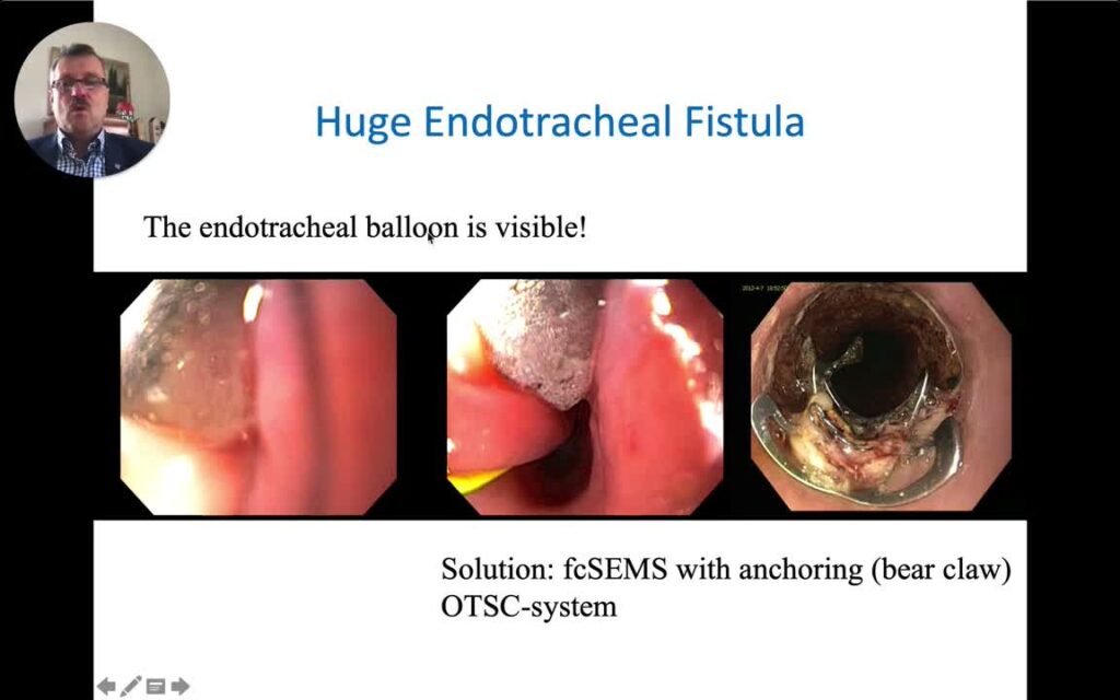 Self-Expanding Metal Stents In Interventional Gi (Part I): Esophagus