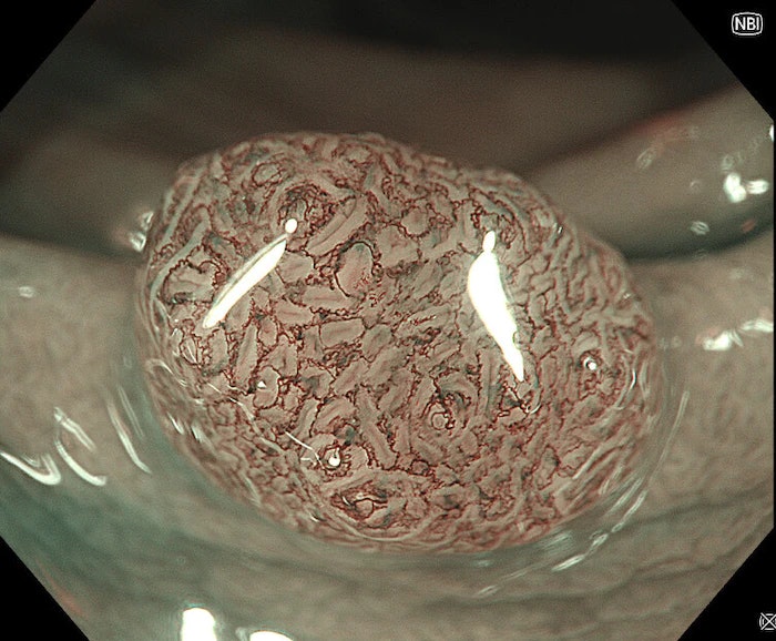 Sessile Adenoma By Dr Serhii Polishchuk