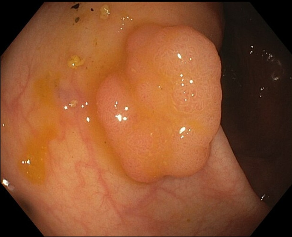 Sessile Tubular Adenoma