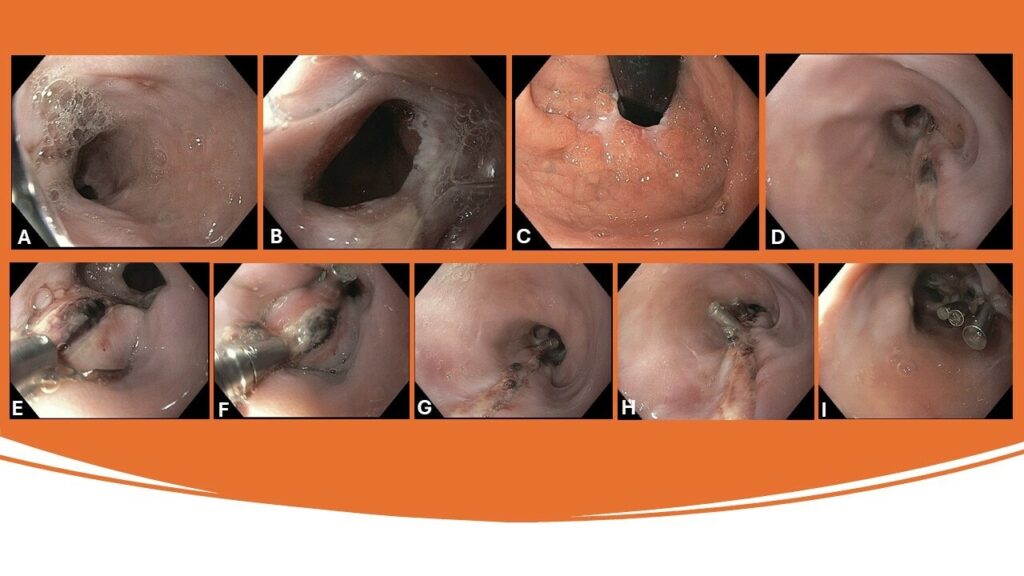 Short Stem Hemoclip (DuraClip)