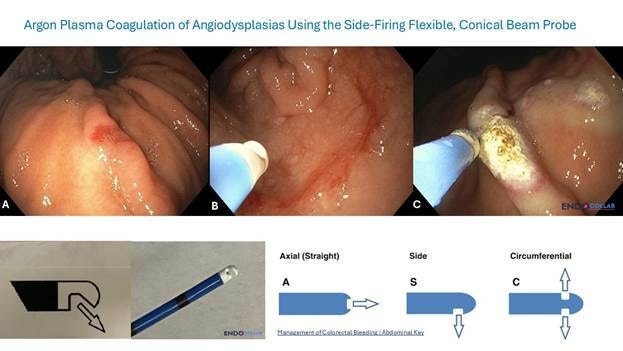 Side Fire flexible Conical Beam Argon Plasma Coagulation Catheter