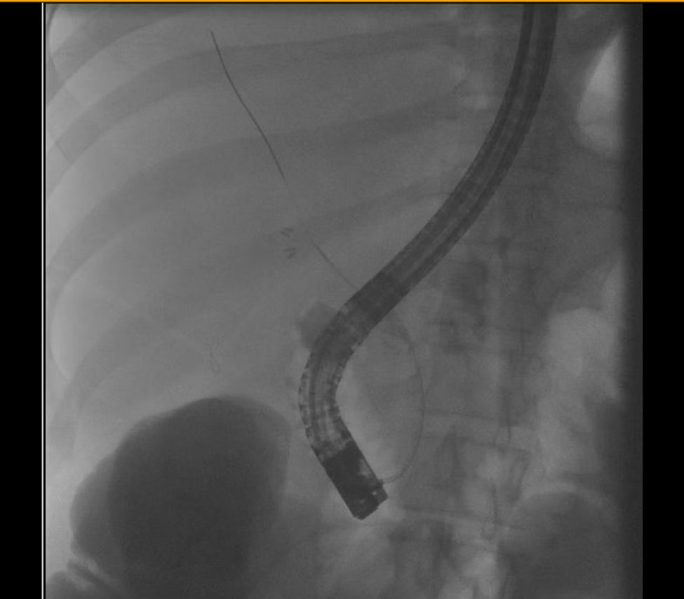 Significant Stapfer Ii Perforation In A Patient With A Bile Leak