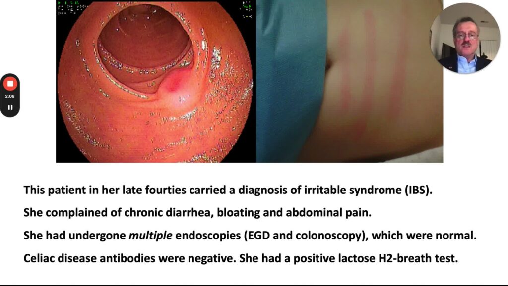 Skin Manifestations of GI Diseases, part 2 โ Glucagonoma, Carcinoid