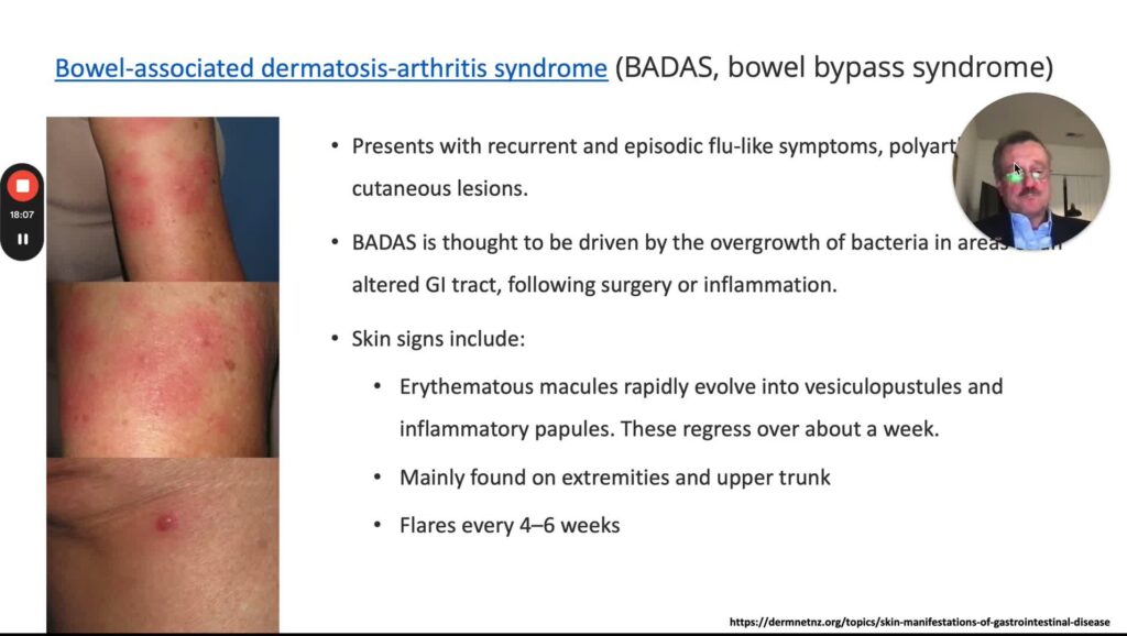 Skin Manifestations Of Gi Diseases, Part 4 (Inflammatory And Autoimmune Diseases)