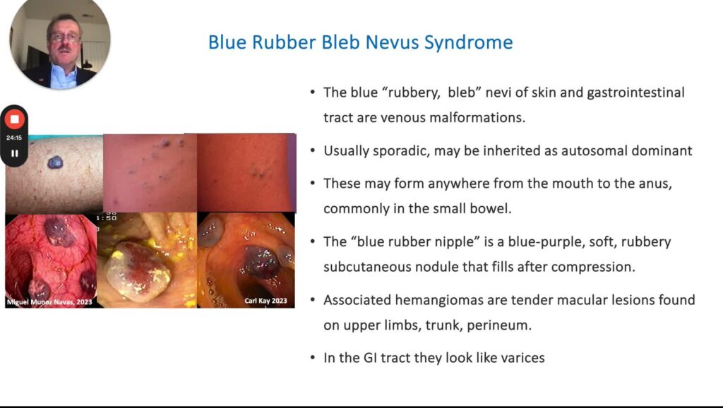 Skin Manifestations Of Gi Diseases, Part 5 – Vascular Disorders