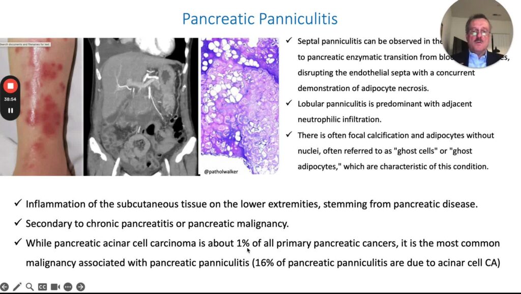 Skin Manifestations of GI Diseases, part 8 – Cirrhosis, Pancreas